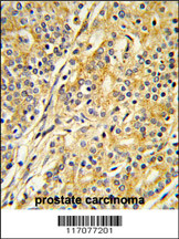 Formalin-fixed and paraffin-embedded human prostate carcinoma reacted with CYP51A1 Antibody (C-term), which was peroxidase-conjugated to the secondary antibody, followed by DAB staining. This data demonstrates the use of this antibody for immunohistochemistry; clinical relevance has not been evaluated.