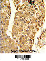 Formalin-fixed and paraffin-embedded human hepatocarcinoma reacted with CYP2C18 Antibody (C-term) ,which was peroxidase-conjugated to the secondary antibody, followed by DAB staining. This data demonstrates the use of this antibody for immunohistochemistry; clinical relevance has not been evaluated.