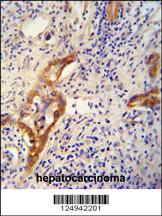 CLPX antibody (C-term) (Cat. #AP10767b) immunohistochemistry analysis in formalin fixed and paraffin embedded human hepatocarcinoma followed by peroxidase conjugation of the secondary antibody and DAB staining. This data demonstrates the use of the CLPX antibody (C-term) for immunohistochemistry. Clinical relevance has not been evaluated.