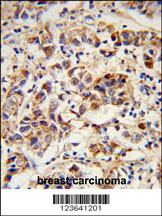 Formalin-fixed and paraffin-embedded human breast carcinoma reacted with SPRR1B Antibody (C-term), which was peroxidase-conjugated to the secondary antibody, followed by DAB staining. This data demonstrates the use of this antibody for immunohistochemistry; clinical relevance has not been evaluated.