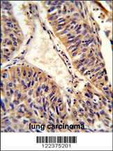 Formalin-fixed and paraffin-embedded human lung carcinoma reacted with ALG14 Antibody (Center), which was peroxidase-conjugated to the secondary antibody, followed by DAB staining. This data demonstrates the use of this antibody for immunohistochemistry; clinical relevance has not been evaluated.