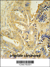 TLL1 antibody (C-term) (Cat. #AP10755b) immunohistochemistry analysis in formalin fixed and paraffin embedded human prostate carcinoma followed by peroxidase conjugation of the secondary antibody and DAB staining. This data demonstrates the use of the TLL1 antibody (C-term) for immunohistochemistry. Clinical relevance has not been evaluated.