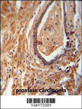 NDUFAF1 antibody (C-term) (Cat. #AP10745b) immunohistochemistry analysis in formalin fixed and paraffin embedded human prostate carcinoma followed by peroxidase conjugation of the secondary antibody and DAB staining. This data demonstrates the use of the NDUFAF1 antibody (C-term) for immunohistochemistry. Clinical relevance has not been evaluated.