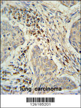 C19orf50 Antibody (Center) (Cat. #AP9140d) immunohistochemistry analysis in formalin fixed and paraffin embedded human lung carcinoma followed by peroxidase conjugation of the secondary antibody and DAB staining. This data demonstrates the use of the C19orf50 Antibody (Center) for immunohistochemistry. Clinical relevance has not been evaluated.