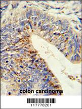 Formalin-fixed and paraffin-embedded human colon carcinoma reacted with ADAMDEC1 Antibody (N-term), which was peroxidase-conjugated to the secondary antibody, followed by DAB staining. This data demonstrates the use of this antibody for immunohistochemistry; clinical relevance has not been evaluated.