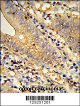 Formalin-fixed and paraffin-embedded human colon carcinoma reacted with TSPAN33 Antibody (C-term), which was peroxidase-conjugated to the secondary antibody, followed by DAB staining. This data demonstrates the use of this antibody for immunohistochemistry; clinical relevance has not been evaluated.