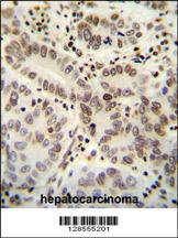 HIST1H2B antibody (Center) (Cat. #AP10727c) immunohistochemistry analysis in formalin fixed and paraffin embedded human hepatocarcinoma followed by peroxidase conjugation of the secondary antibody and DAB staining. This data demonstrates the use of the HIST1H2B antibody (Center) for immunohistochemistry. Clinical relevance has not been evaluated.