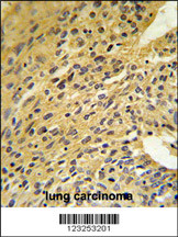 COQ5 Antibody (Center) (Cat. #AP9319c) IHC analysis in formalin fixed and paraffin embedded human lung carcinoma followed by peroxidase conjugation of the secondary antibody and DAB staining. This data demonstrates the use of the COQ5 Antibody (Center) for immunohistochemistry. Clinical relevance has not been evaluated.