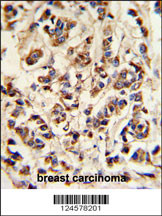 ATP6V1A Antibody (Center) (Cat. #AP9778b) IHC analysis in formalin fixed and paraffin embedded breast carcinoma followed by peroxidase conjugation of the secondary antibody and DAB staining. This data demonstrates the use of the ATP6V1A Antibody (Center) for immunohistochemistry. Clinical relevance has not been evaluated.