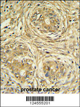 SUPV3L1 Antibody (N-term) (Cat. #AP9772a) IHC analysis in formalin fixed and paraffin embedded prostate carcinoma followed by peroxidase conjugation of the secondary antibody and DAB staining. This data demonstrates the use of the SUPV3L1 Antibody (N-term) for immunohistochemistry. Clinical relevance has not been evaluated.