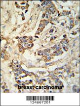 MRAP Antibody (N-term) (Cat. #AP9980a) IHC analysis in formalin fixed and paraffin embedded breast carcinoma followed by peroxidase conjugation of the secondary antibody and DAB staining. This data demonstrates the use of the MRAP Antibody (N-term) for immunohistochemistry. Clinical relevance has not been evaluated.