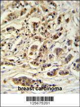 M11D1 Antibody (N-term) (Cat. #AP9974a) IHC analysis in formalin fixed and paraffin embedded breast carcinoma followed by peroxidase conjugation of the secondary antibody and DAB staining. This data demonstrates the use of the M11D1 Antibody (N-term) for immunohistochemistry. Clinical relevance has not been evaluated.