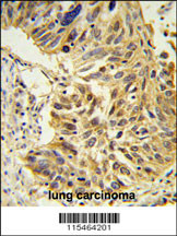 SDR Antibody (Center) (Cat. #AP9935c) IHC analysis in formalin fixed and paraffin embedded lung carcinoma followed by peroxidase conjugation of the secondary antibody and DAB staining. This data demonstrates the use of the SDR Antibody (Center) for immunohistochemistry. Clinical relevance has not been evaluated.