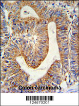 RPL17 Antibody (C-term) (Cat. #AP9892b) IHC analysis in formalin fixed and paraffin embedded colon carcinoma followed by peroxidase conjugation of the secondary antibody and DAB staining. This data demonstrates the use of the RPL17 Antibody (C-term) for immunohistochemistry. Clinical relevance has not been evaluated.
