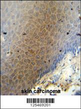 CEP70 antibody (Center) (Cat. #AP10646c) immunohistochemistry analysis in formalin fixed and paraffin embedded human skin carcinoma followed by peroxidase conjugation of the secondary antibody and DAB staining. This data demonstrates the use of the CEP70 antibody (Center) for immunohistochemistry. Clinical relevance has not been evaluated.