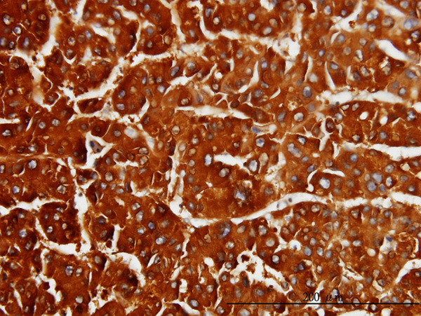 Immunoperoxidase of monoclonal antibody to CBS on formalin-fixed paraffin-embedded human hepatocellular carcinoma. [antibody concentration 3 ug/ml]