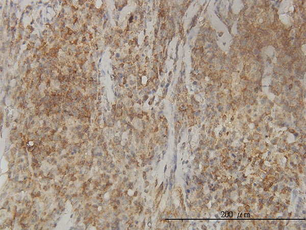 Immunoperoxidase of monoclonal antibody to CAB39L on formalin-fixed paraffin-embedded human lymphoma tissue. [antibody concentration 3 ug/ml]