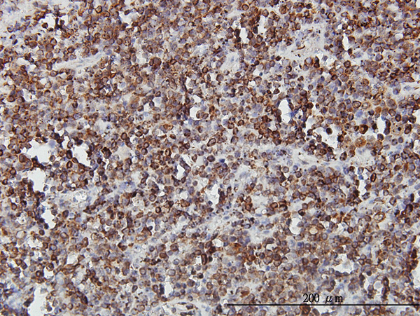Immunoperoxidase of monoclonal antibody to SLC44A2 on formalin-fixed paraffin-embedded human lymphoma. [antibody concentration 3 ug/ml]
