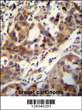 CCDC17 antibody (C-term) (Cat. #AP11038b) immunohistochemistry analysis in formalin fixed and paraffin embedded human breast carcinoma followed by peroxidase conjugation of the secondary antibody and DAB staining.This data demonstrates the use of the CCDC17 antibody (C-term) for immunohistochemistry. Clinical relevance has not been evaluated.