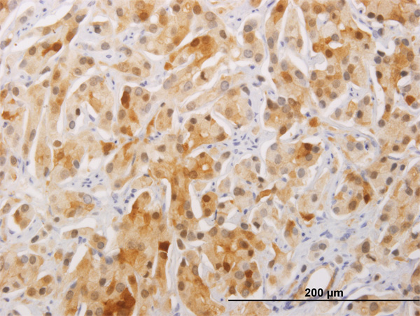 Immunoperoxidase of monoclonal antibody to FAM84A on formalin-fixed paraffin-embedded human prostate cancer. [antibody concentration 5 ug/ml]