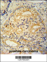 CP013 antibody (N-term) (Cat. #AP11012a) immunohistochemistry analysis in formalin fixed and paraffin embedded human prostate carcinoma followed by peroxidase conjugation of the secondary antibody and DAB staining. This data demonstrates the use of the CP013 antibody (N-term) for immunohistochemistry. Clinical relevance has not been evaluated.