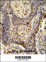 PPRC1 antibody (C-term) (Cat. #AP11011c) immunohistochemistry analysis in formalin fixed and paraffin embedded human lung carcinoma followed by peroxidase conjugation of the secondary antibody and DAB staining. This data demonstrates the use of the PPRC1 antibody (C-term) for immunohistochemistry. Clinical relevance has not been evaluated.