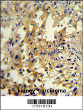 UPP2 antibody (C-term) (Cat. #AP10995b) immunohistochemistry analysis in formalin fixed and paraffin embedded human kidney carcinoma followed by peroxidase conjugation of the secondary antibody and DAB staining. This data demonstrates the use of the UPP2 antibody (C-term) for immunohistochemistry. Clinical relevance has not been evaluated.