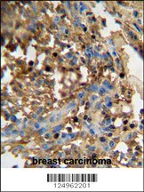 DMP4 antibody (C-term) (Cat. #AP10983b) immunohistochemistry analysis in formalin fixed and paraffin embedded human breast carcinoma followed by peroxidase conjugation of the secondary antibody and DAB staining. This data demonstrates the use of the DMP4 antibody (C-term) for immunohistochemistry. Clinical relevance has not been evaluated.