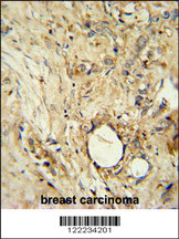 ITIH5 Antibody (C-term) (Cat. #AP10965b) immunohistochemistry analysis in formalin fixed and paraffin embedded human breast carcinoma followed by peroxidase conjugation of the secondary antibody and DAB staining. This data demonstrates the use of the ITIH5 Antibody (C-term) for immunohistochemistry. Clinical relevance has not been evaluated.