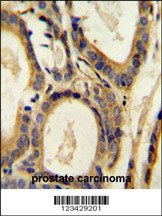 CCL4 Antibody (Center) (Cat. #AP10172b) immunohistochemistry analysis in formalin fixed and paraffin embedded human prostate carcinoma followed by peroxidase conjugation of the secondary antibody and DAB staining. This data demonstrates the use of the CCL4 Antibody (Center) for immunohistochemistry. Clinical relevance has not been evaluated.