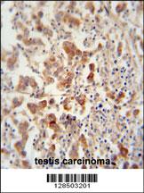 TEX13B antibody (C-term) (Cat. #AP10895b) immunohistochemistry analysis in formalin fixed and paraffin embedded human testis carcinoma followed by peroxidase conjugation of the secondary antibody and DAB staining. This data demonstrates the use of the TEX13B antibody (C-term) for immunohistochemistry. Clinical relevance has not been evaluated.