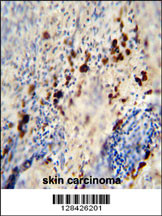 LCE1A antibody (C-term) (Cat. #AP10891b) immunohistochemistry analysis in formalin fixed and paraffin embedded human skin carcinoma followed by peroxidase conjugation of the secondary antibody and DAB staining. This data demonstrates the use of the LCE1A antibody (C-term) for immunohistochemistry. Clinical relevance has not been evaluated.