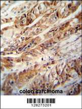 ZC3H15 antibody (C-term) (Cat. #AP10865b) immunohistochemistry analysis in formalin fixed and paraffin embedded human colon carcinoma followed by peroxidase conjugation of the secondary antibody and DAB staining. This data demonstrates the use of the ZC3H15 antibody (C-term) for immunohistochemistry. Clinical relevance has not been evaluated.