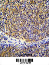 PSMB11 Antibody (C-term) (Cat. #AP11339b)immunohistochemistry analysis in formalin fixed and paraffin embedded human thymoma followed by peroxidase conjugation of the secondary antibody and DAB staining.This data demonstrates the use of PSMB11 Antibody (C-term) for immunohistochemistry. Clinical relevance has not been evaluated.