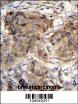 TTC9C Antibody (N-term) (Cat. #AP11171a)immunohistochemistry analysis in formalin fixed and paraffin embedded human breast carcinoma followed by peroxidase conjugation of the secondary antibody and DAB staining.This data demonstrates the use of TTC9C Antibody (N-term) for immunohistochemistry. Clinical relevance has not been evaluated.