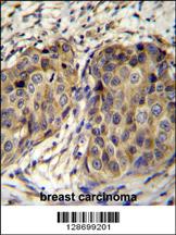 JAGN1 Antibody (N-term) (Cat. #AP11155a)immunohistochemistry analysis in formalin fixed and paraffin embedded human breast carcinoma followed by peroxidase conjugation of the secondary antibody and DAB staining.This data demonstrates the use of JAGN1 Antibody (N-term) for immunohistochemistry. Clinical relevance has not been evaluated.