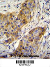 ANR39 Antibody (C-term) (Cat. #AP11153b)immunohistochemistry analysis in formalin fixed and paraffin embedded human breast carcinoma followed by peroxidase conjugation of the secondary antibody and DAB staining.This data demonstrates the use of ANR39 Antibody (C-term) for immunohistochemistry. Clinical relevance has not been evaluated.