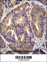 GTF2H2C Antibody (C-term) (Cat. #AP11425b)immunohistochemistry analysis in formalin fixed and paraffin embedded human prostate carcinoma followed by peroxidase conjugation of the secondary antibody and DAB staining.This data demonstrates the use of GTF2H2C Antibody (C-term) for immunohistochemistry. Clinical relevance has not been evaluated.