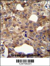 CCNI2 Antibody (Center) (Cat. #AP11897c)immunohistochemistry analysis in formalin fixed and paraffin embedded human breast carcinoma followed by peroxidase conjugation of the secondary antibody and DAB staining.This data demonstrates the use of CCNI2 Antibody (Center) for immunohistochemistry. Clinical relevance has not been evaluated.