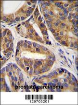 RNF215 Antibody (C-term) (Cat. #AP11895b)immunohistochemistry analysis in formalin fixed and paraffin embedded human prostate carcinoma tissue followed by peroxidase conjugation of the secondary antibody and DAB staining.This data demonstrates the use of RNF215 Antibody (C-term) for immunohistochemistry. Clinical relevance has not been evaluated.
