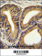 TRIM65 Antibody (Center) (Cat. #AP11814c)immunohistochemistry analysis in formalin fixed and paraffin embedded human prostate carcinoma followed by peroxidase conjugation of the secondary antibody and DAB staining.This data demonstrates the use of TRIM65 Antibody (Center) for immunohistochemistry. Clinical relevance has not been evaluated.