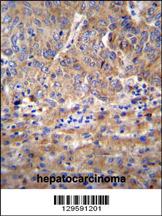 DEF Antibody (N-term) (Cat. #AP11810a)immunohistochemistry analysis in formalin fixed and paraffin embedded human hepatocarcinoma followed by peroxidase conjugation of the secondary antibody and DAB staining.This data demonstrates the use of DEF Antibody (N-term) for immunohistochemistry. Clinical relevance has not been evaluated.