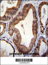 SHQ1 Antibody (N-term) (Cat. #AP11715a)immunohistochemistry analysis in formalin fixed and paraffin embedded human prostate carcinoma followed by peroxidase conjugation of the secondary antibody and DAB staining.This data demonstrates the use of SHQ1 Antibody (N-term) for immunohistochemistry. Clinical relevance has not been evaluated.