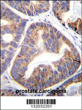 FAM109A Antibody (N-term) (Cat. #AP12167a)immunohistochemistry analysis in formalin fixed and paraffin embedded human prostate carcinoma followed by peroxidase conjugation of the secondary antibody and DAB staining.This data demonstrates the use of FAM109A Antibody (N-term) for immunohistochemistry. Clinical relevance has not been evaluated.
