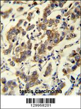 MBD3L3 Antibody (C-term) (Cat. #AP12132b)immunohistochemistry analysis in formalin fixed and paraffin embedded human testis carcinoma followed by peroxidase conjugation of the secondary antibody and DAB staining.This data demonstrates the use of MBD3L3 Antibody (C-term) for immunohistochemistry. Clinical relevance has not been evaluated.