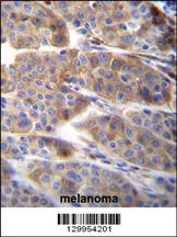 PLA2G2C Antibody (C-term) (Cat. #AP11996b)immunohistochemistry analysis in formalin fixed and paraffin embedded human melanoma followed by peroxidase conjugation of the secondary antibody and DAB staining.This data demonstrates the use of PLA2G2C Antibody (C-term) for immunohistochemistry. Clinical relevance has not been evaluated.