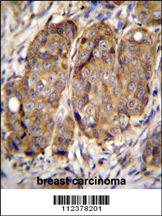 METTL2 Antibody (C-term) (Cat. #AP11952b)immunohistochemistry analysis in formalin fixed and paraffin embedded human breast carcinoma followed by peroxidase conjugation of the secondary antibody and DAB staining.This data demonstrates the use of METTL2 Antibody (C-term) for immunohistochemistry. Clinical relevance has not been evaluated.