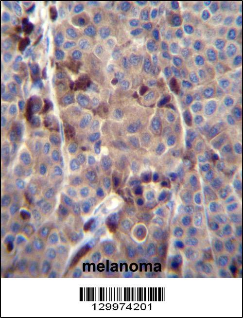 PRAMEF8 Antibody (C-term) (Cat. #AP12211b)immunohistochemistry analysis in formalin fixed and paraffin embedded human melanoma tissue followed by peroxidase conjugation of the secondary antibody and DAB staining.This data demonstrates the use of PRAMEF8 Antibody (C-term) for immunohistochemistry. Clinical relevance has not been evaluated.