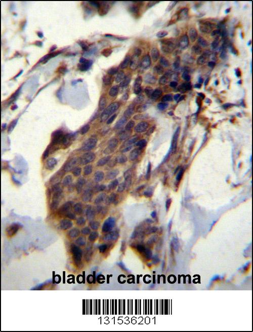 CCDC13 Antibody (N-term) (Cat. #AP12686a)immunohistochemistry analysis in formalin fixed and paraffin embedded human bladder carcinoma followed by peroxidase conjugation of the secondary antibody and DAB staining.This data demonstrates the use of CCDC13 Antibody (N-term) for immunohistochemistry. Clinical relevance has not been evaluated.