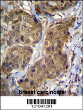 RNF11 Antibody (Center) (Cat. #AP12908c)immunohistochemistry analysis in formalin fixed and paraffin embedded human breast carcinoma followed by peroxidase conjugation of the secondary antibody and DAB staining.This data demonstrates the use of RNF11 Antibody (Center) for immunohistochemistry. Clinical relevance has not been evaluated.